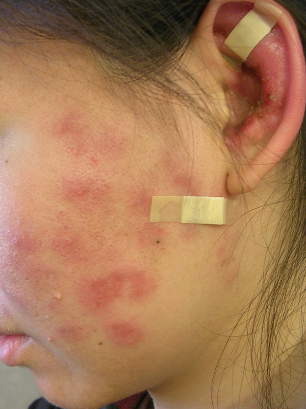 skin rashes on face